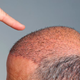 Illustration for article titled Hair Transplant In Islamabad, Pakistanem/em